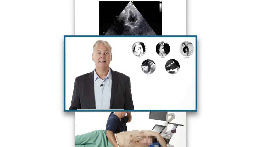 Marfan syndrome