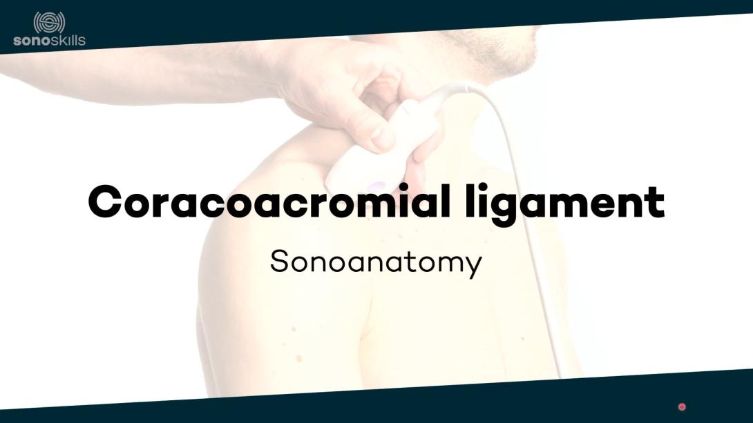 Coracoacromial ligament - sonoanatomy