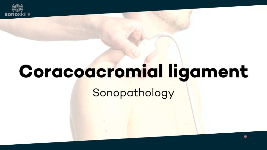 Coracoacromial ligament - sonopathology