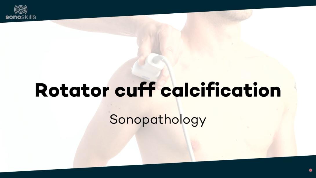 Rotator cuff calcification - sonopathology
