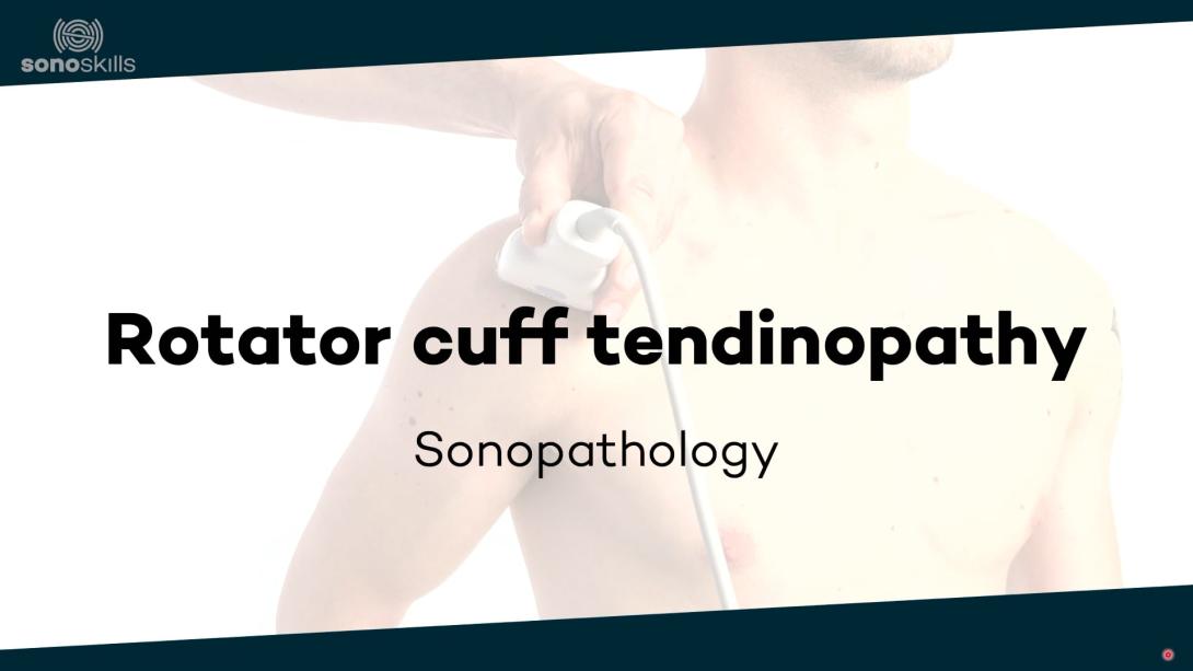 Rotator cuff tendinopathy - sonopathology