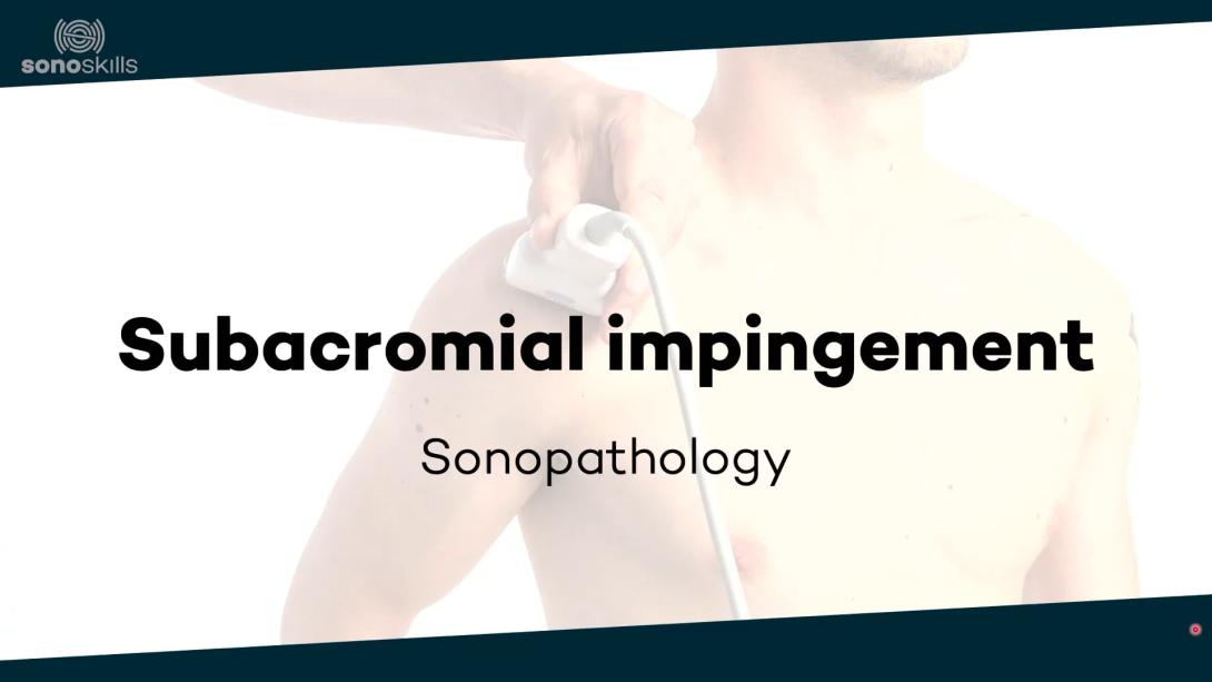 Subacromial impingement - sonopathology