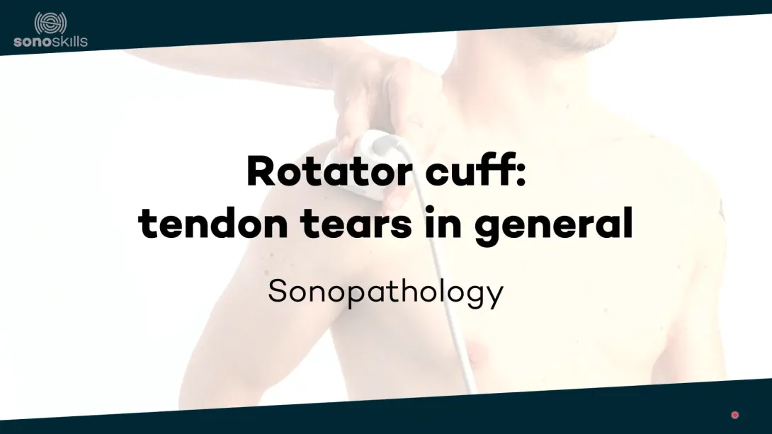 Supraspinatus tendon tears in general - sonopathology