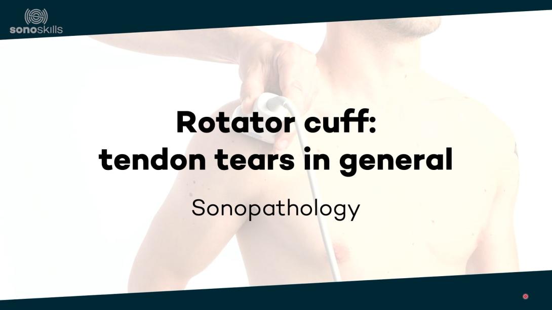 Supraspinatus tendon tears in general - sonopathology
