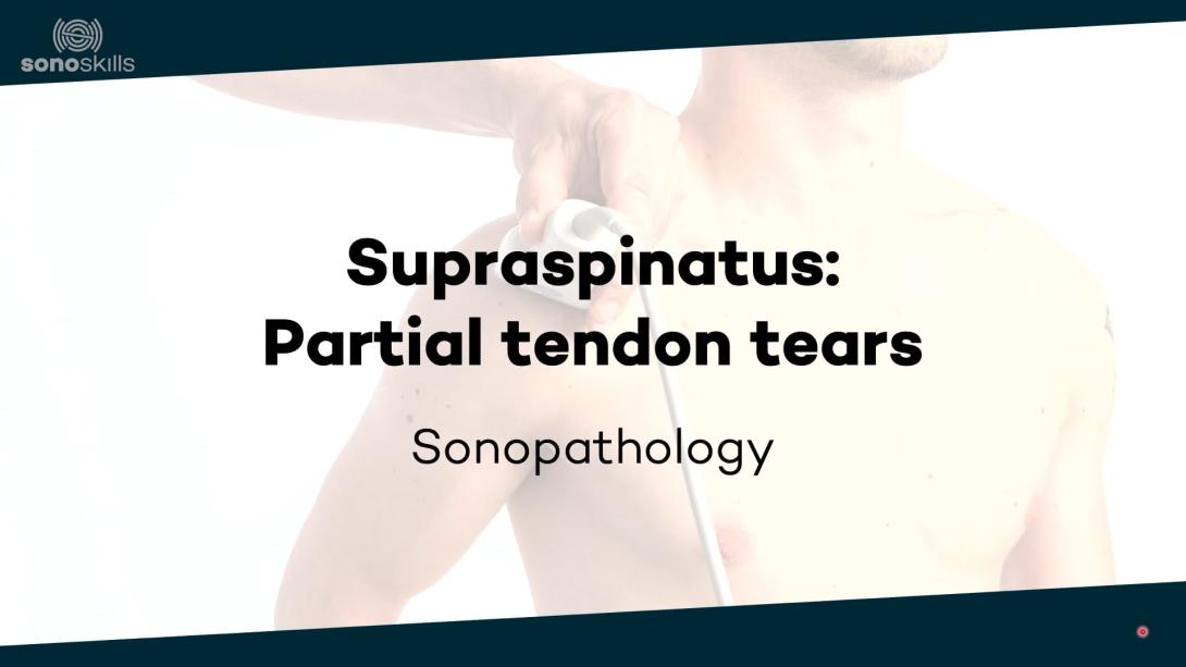 Supraspinatus partial tear - sonopathology