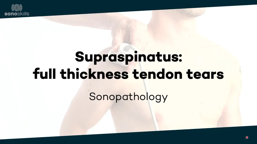 Supraspinatus full thickness tendon tears - sonopathology
