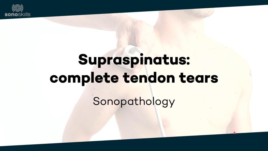 Supraspinatus complete tendon tears - sonopathology