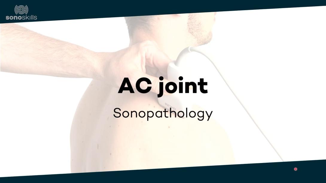 AC joint - sonopathology