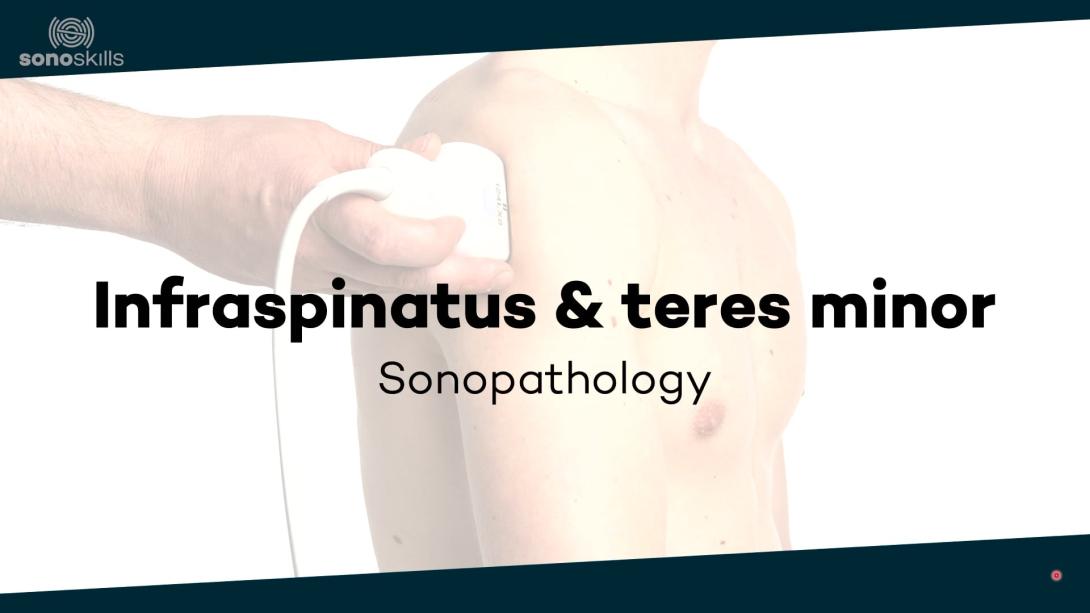 Infraspinatus / teres minor - sonopathology