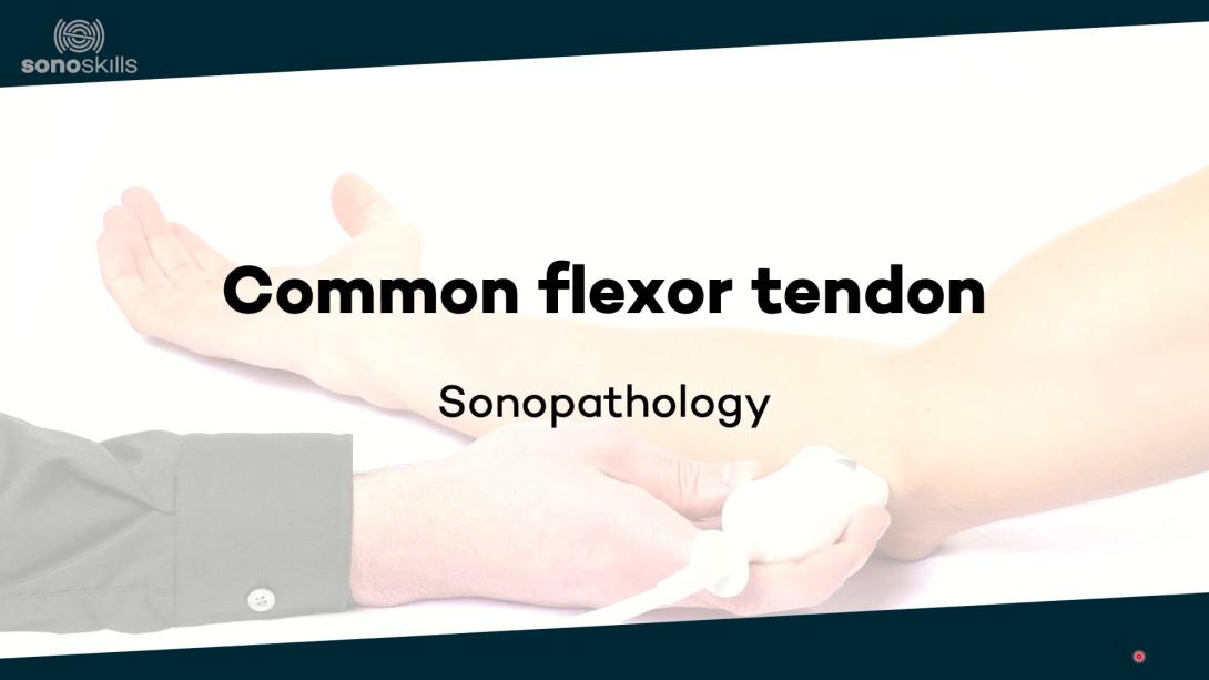 Common flexor tendon - Sonopathology