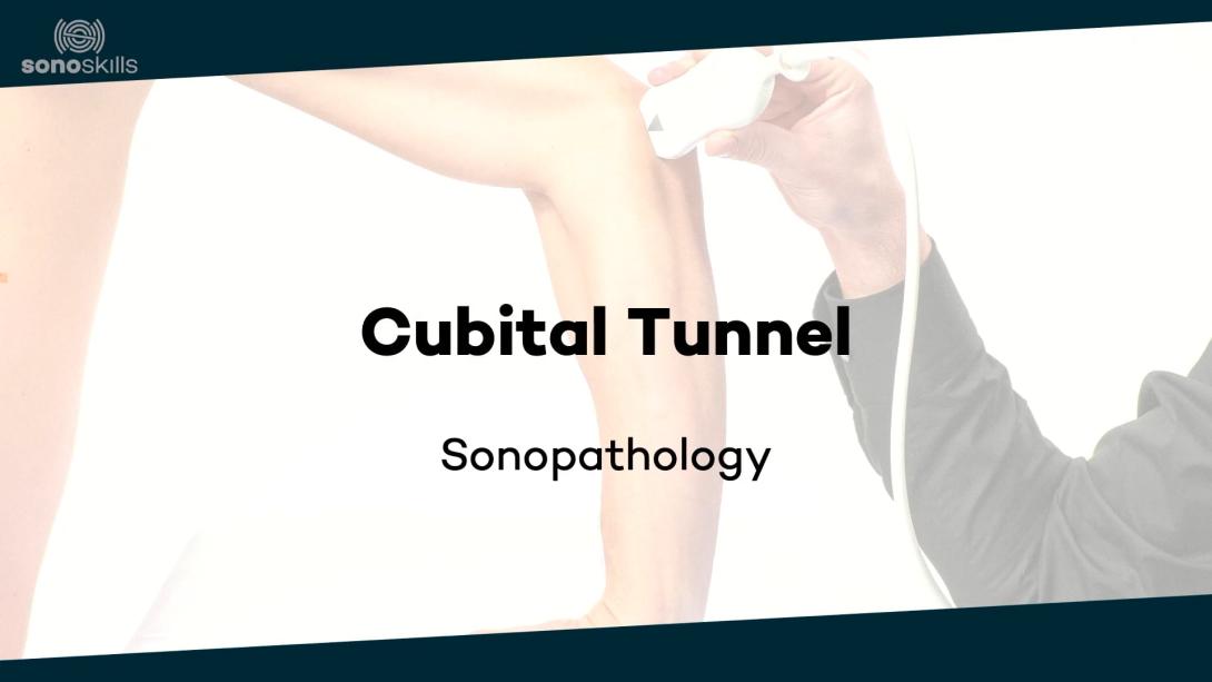Cubital tunnel - sonopathology