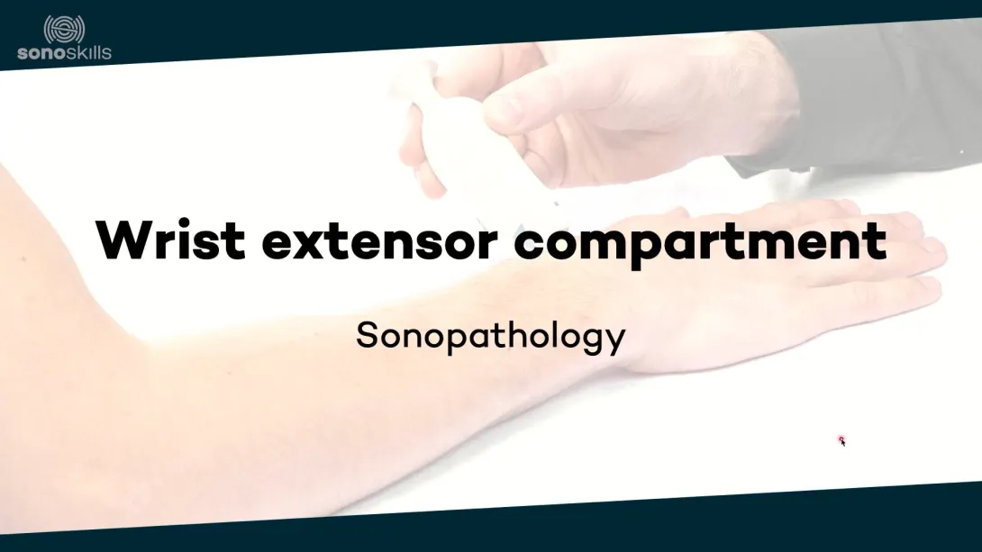 Extensor compartent - sonopathology