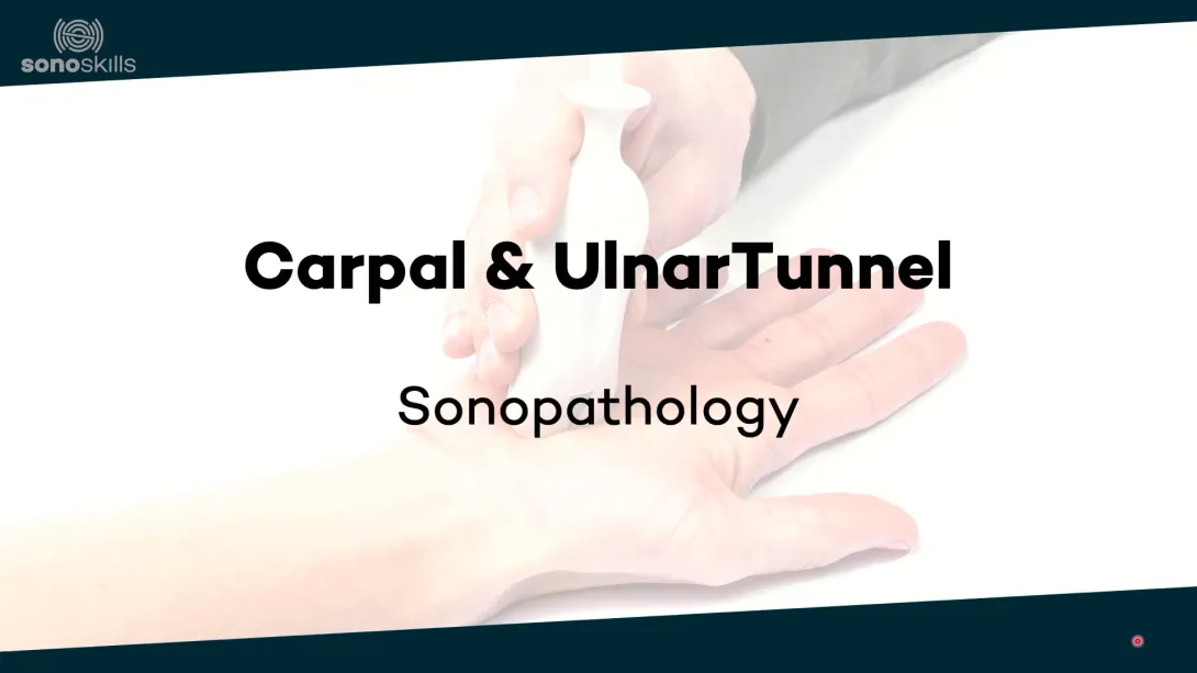 Median nerve - Sonopathology