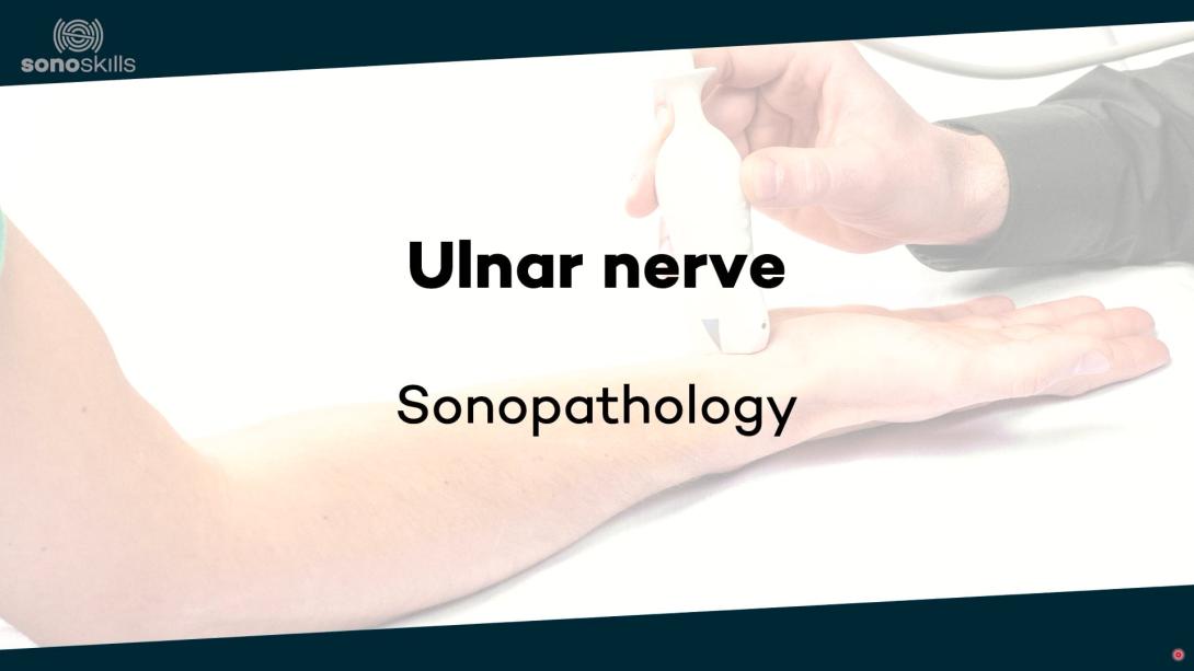 Ulnar nerve - sonopathology