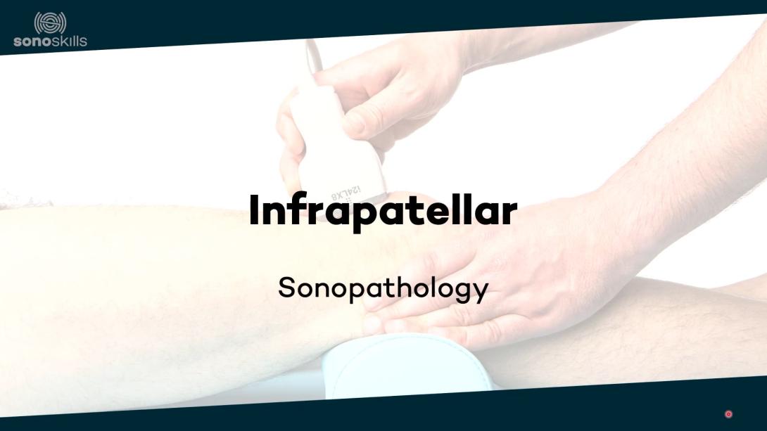 Infrapatellar - sonopathology