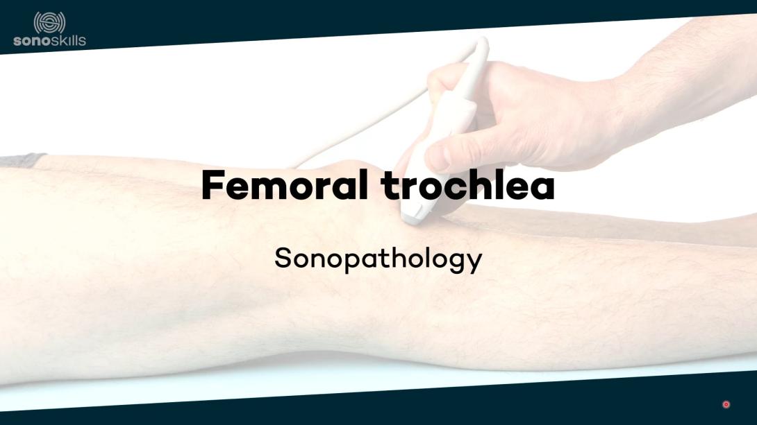 Femoral trochlea - sonopathology