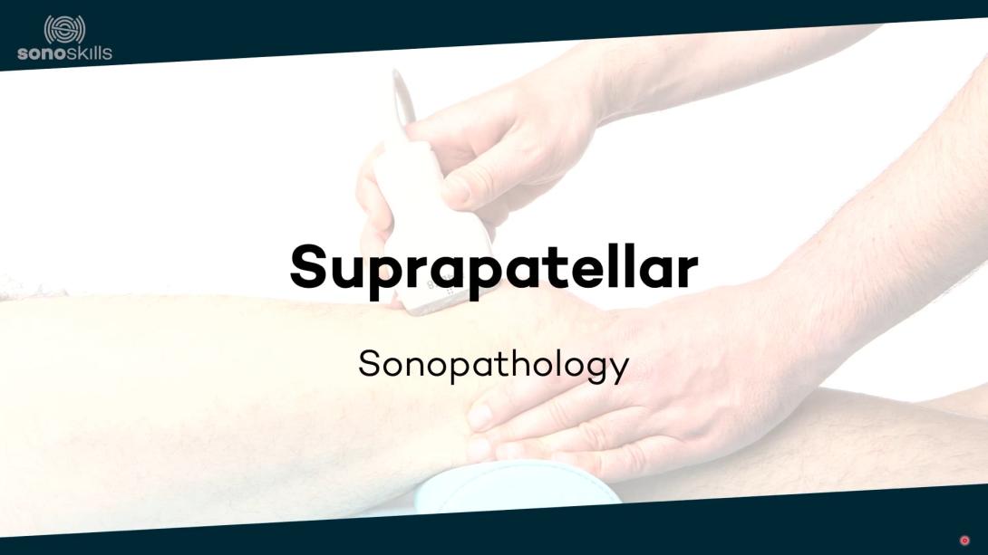 Suprapatellar - sonopathology