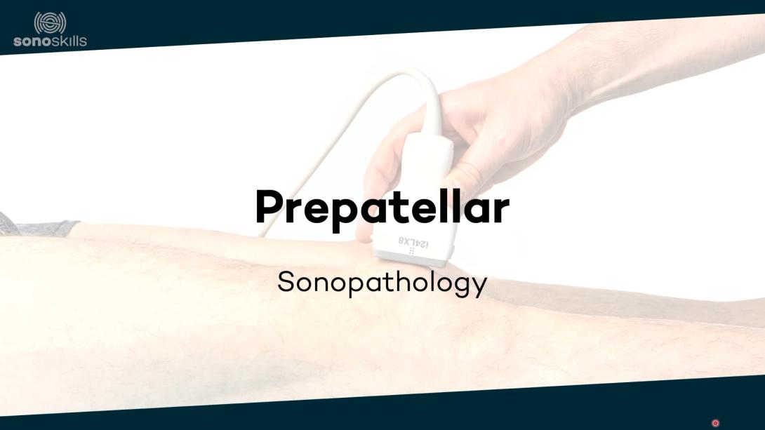 Prepatellar - sonopathology