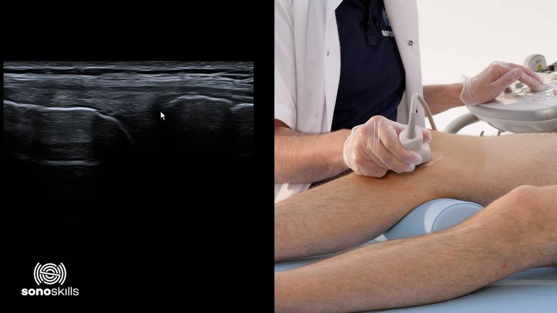 Medial collateral ligament, medial meniscus, pes anserinus - hands-on LAX