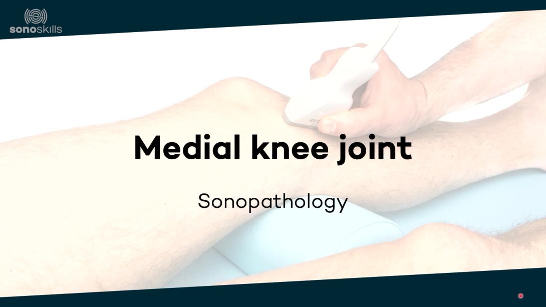 Medial knee joint - sonopathology