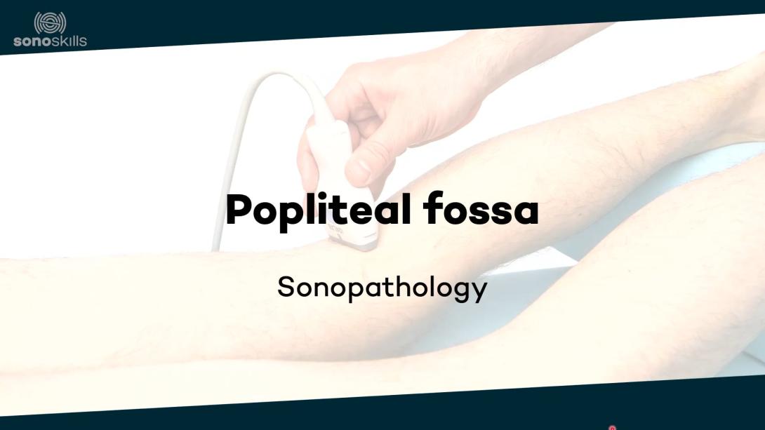 Popliteal fossa - sonopathology