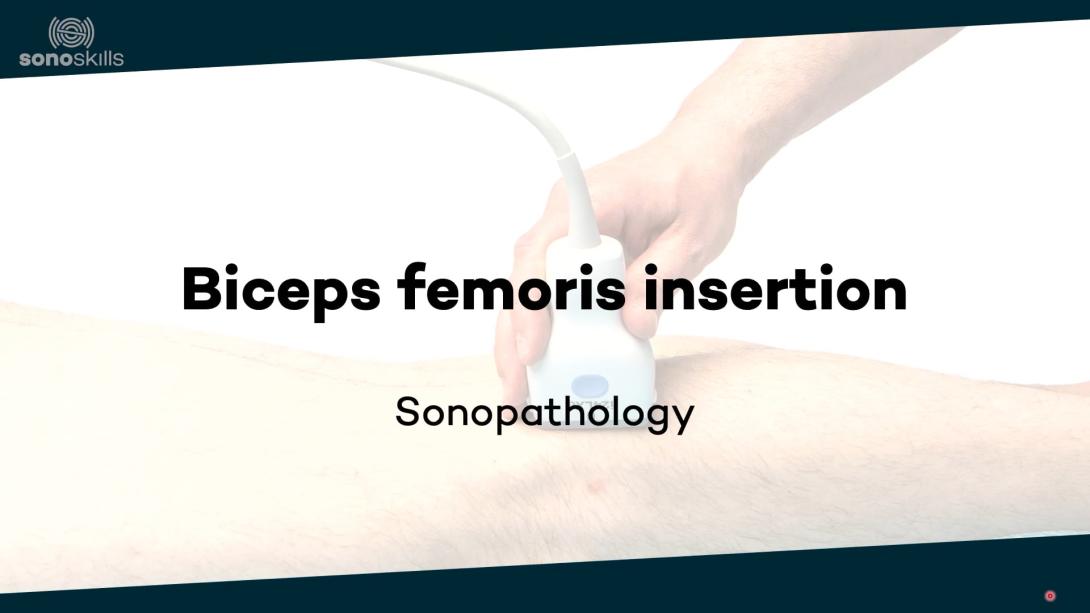Biceps femoris insertion - sonopathology