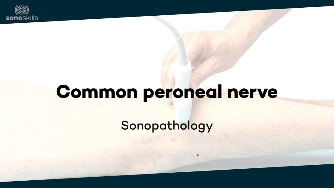 Common peroneal nerve - sonopathology