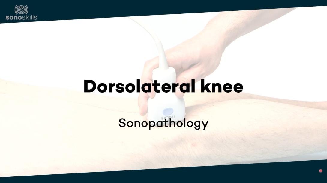 Dorsolateral knee - sonopathology