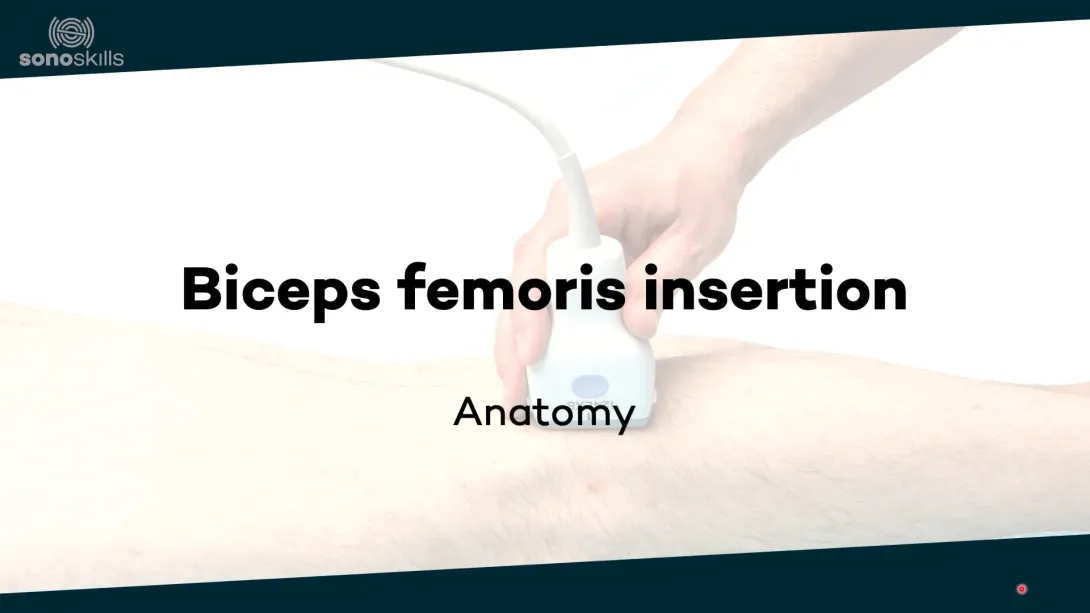 Biceps femoris insertion - anatomy