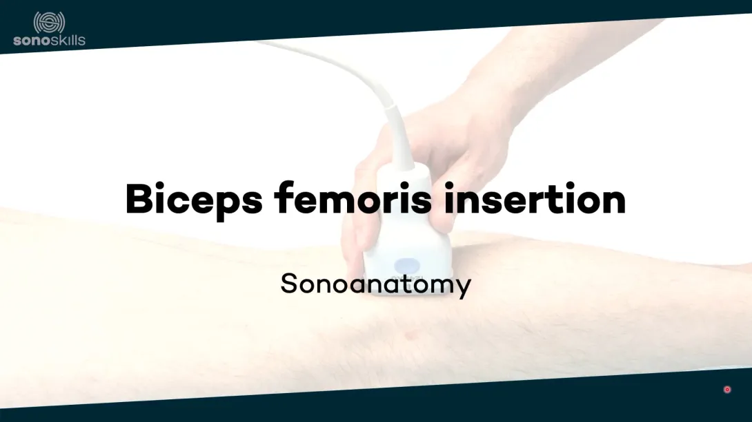 Biceps femoris insertion - sonoanatomy