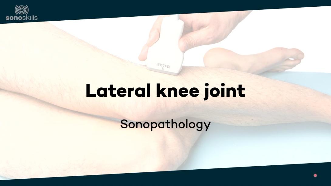 Lateral knee joint - sonopathology