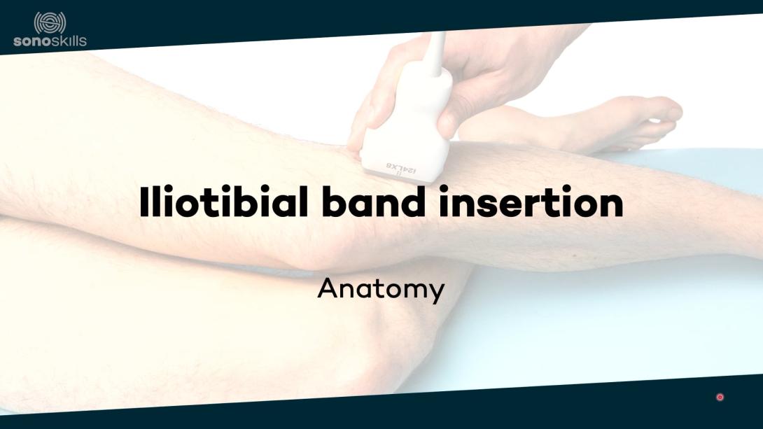 Iliotibial band insertion - anatomy