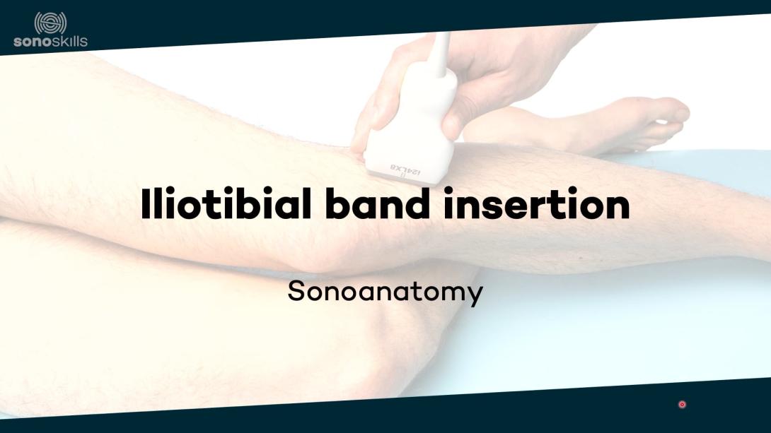 Iliotibial band insertion - sonoanatomy