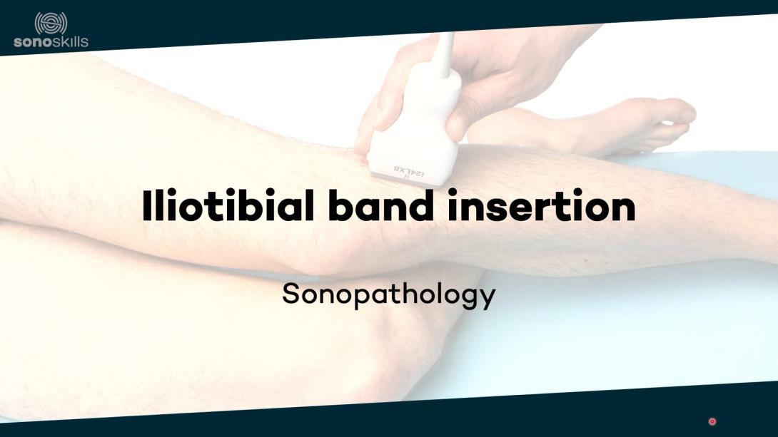 Iliotibial band insertion  - sonopathology