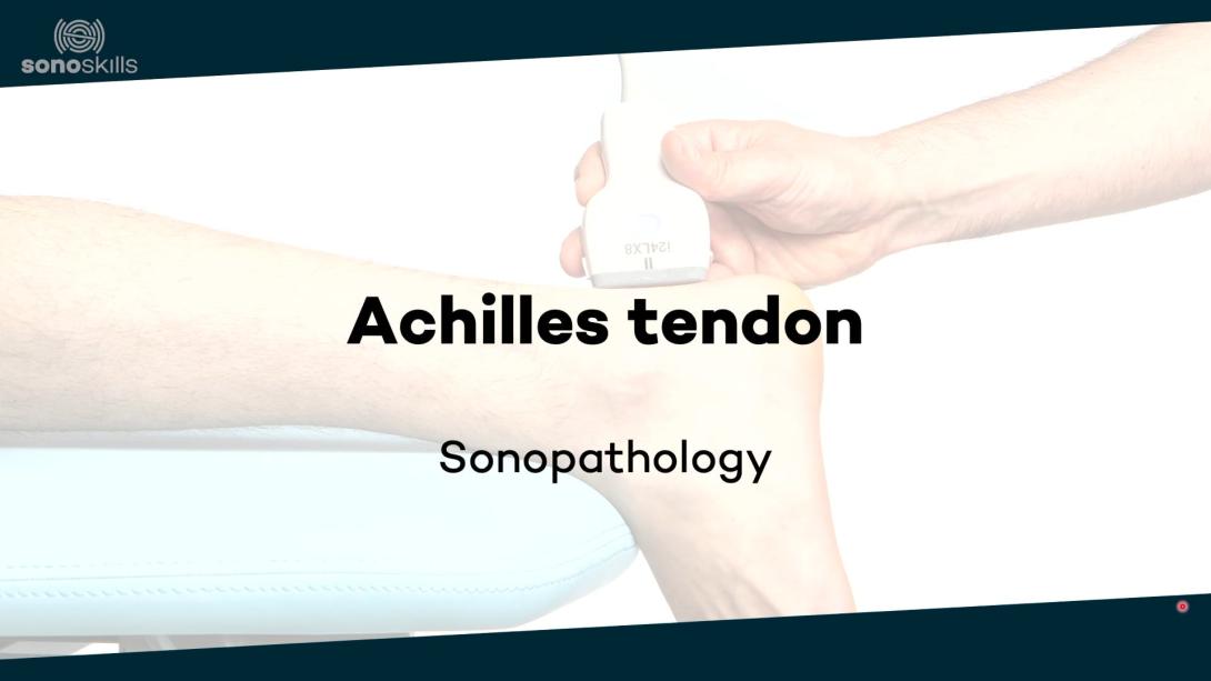 Achilles tendon and calf - sonopathology