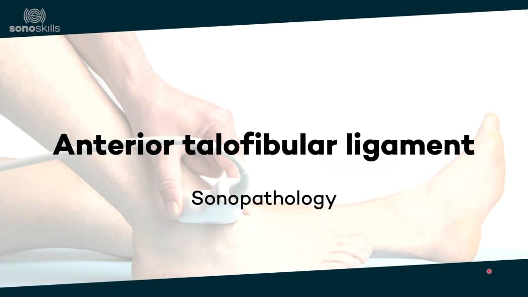 Anterior talofibular ligament - sonopathology