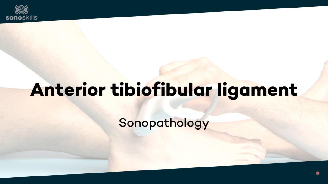 Anterior tibiofibular ligament - sonopathology