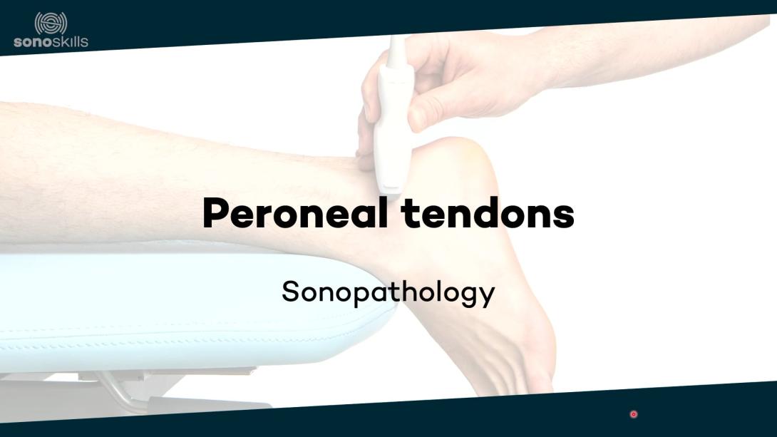 Peroneal tendons - sonopathology
