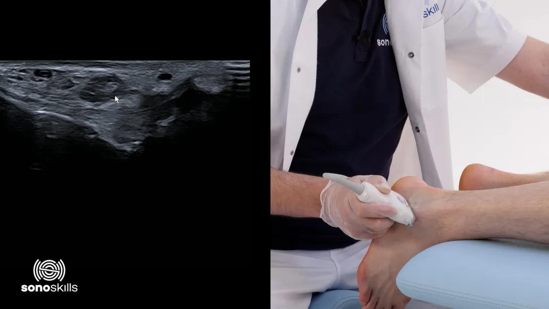 Calcaneofibular ligament - longitudinal