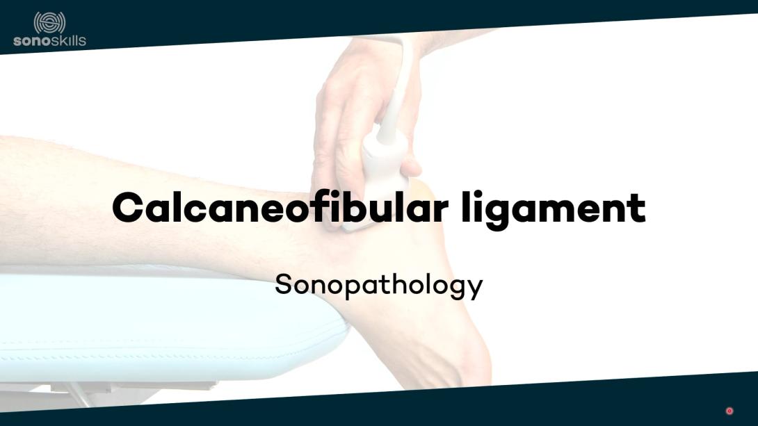 Calcaneofibular ligament - sonopathology
