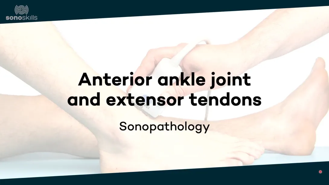 Anterior ankle joint and tendons - sonopathology