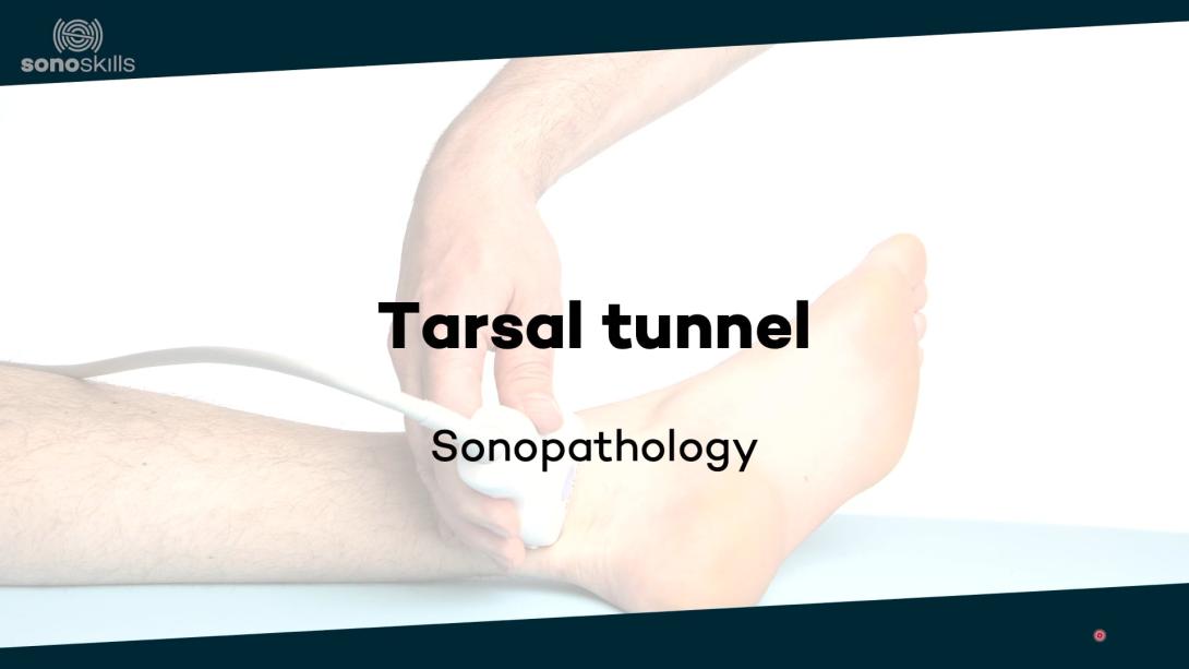Tarsal tunnel - sonopathology
