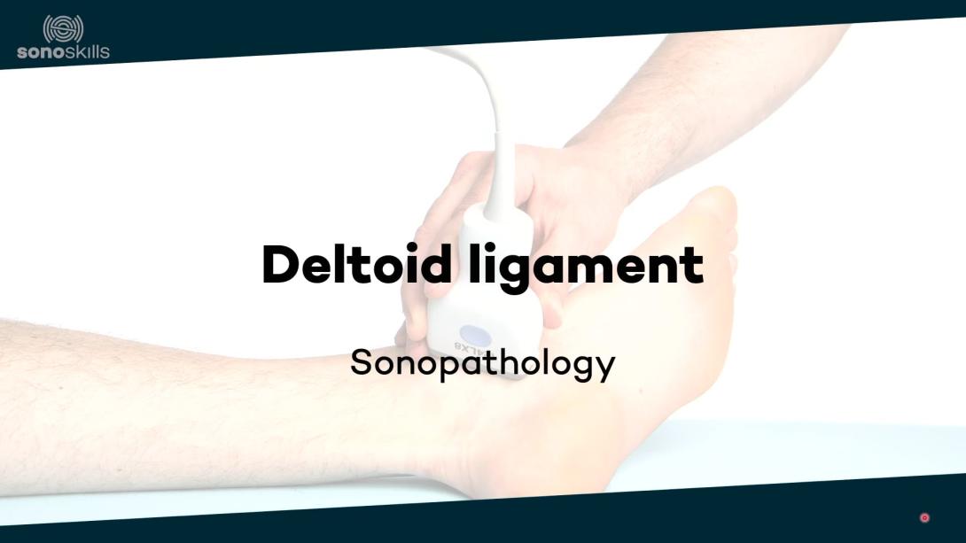 Deltoid ligament - sonopathology