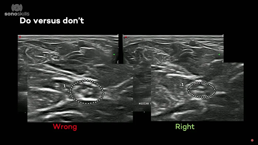 Measuring nerves: CSA, diameters and ratios