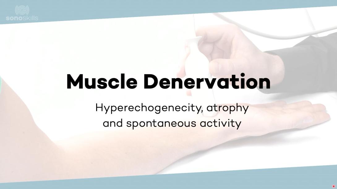 Muscle denervation: hyperechogenicity, atrophy and spontaneous activity