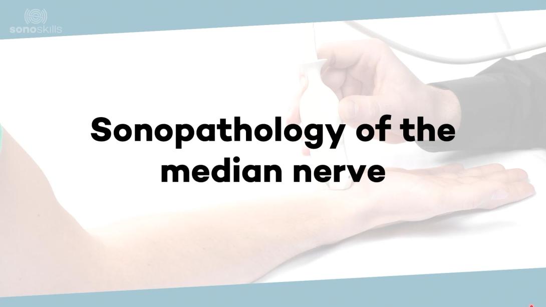 (Sono)pathology of the median neuropathy-wrist