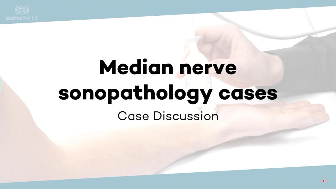 Sonopathology of the median nerve - Part 1
