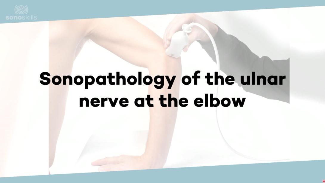(Sono)pathology of ulnar neuropathy—elbow