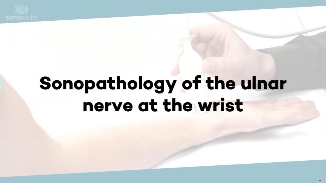 (Sono)pathology of ulnar neuropathy—wrist