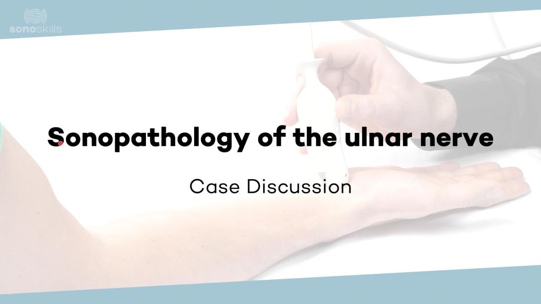 Sonopathology of the ulnar nerve - Part 1